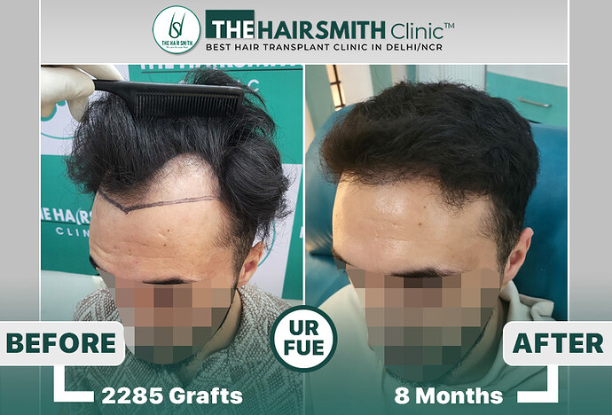 the hairsmith clinic hair transplant result #hairtransplant #hairsmithhairtransplant #hairregrowth