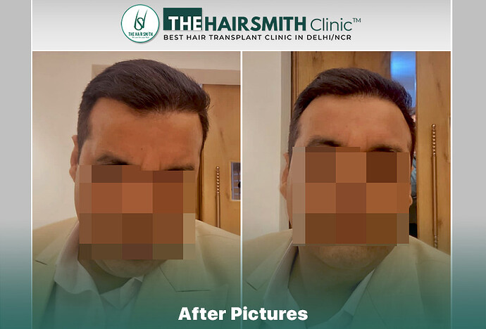 hairsmith hair transplant result after 11 months