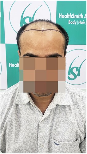 Before Hair Transplant HS 814 - The Hairsmith Clinic Delhi India - 1