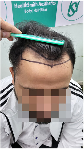 Before Hair Transplant HS 828- The Hairsmith Clinic Delhi India - 3
