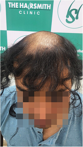 Before Hair Transplant HS 822- The Hairsmith Clinic Delhi India (1)