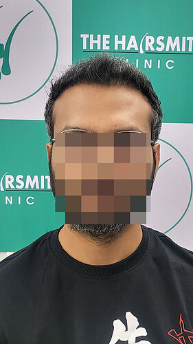 Hair Transplant Result - After 06 Months -  photo 1 - The Hairsmith Clinic