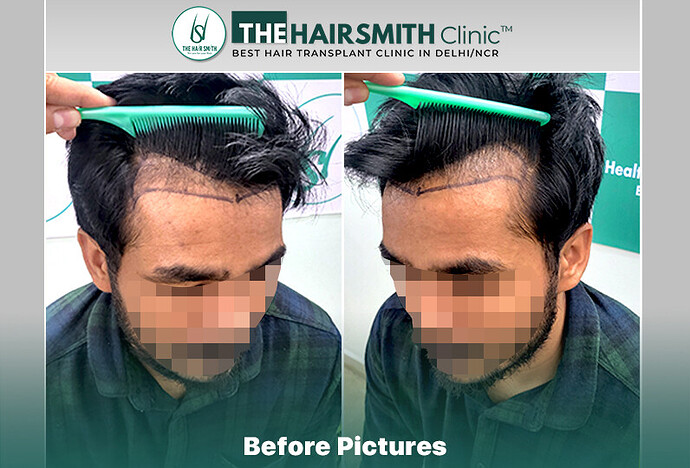 Before Hair Transplant HS 835- #hairtransplant #thehairsmithclinic #urfuehairtransplant #hairsmithhairtransplant