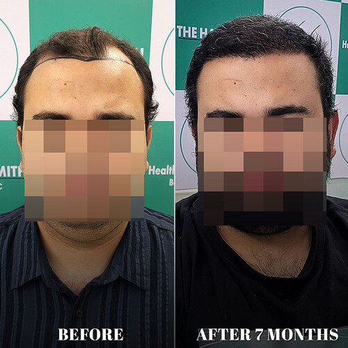 After 07 months hair transplant result update at the hairsmith clinic delhi india (1)