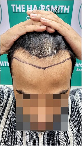 Before Hair Transplant HS823- The Hairsmith Clinic Delhi India (b)
