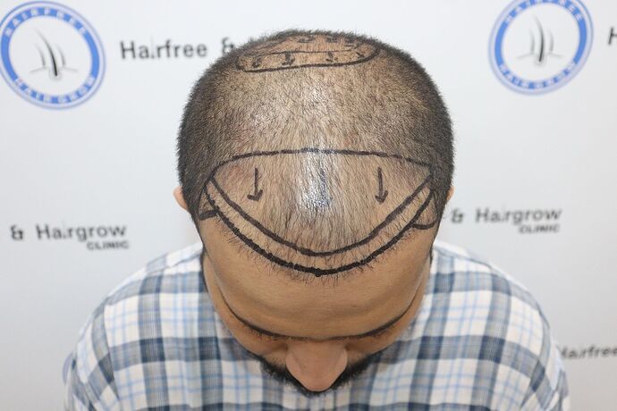 hairlinemarking