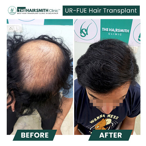 Amazing hair transplant result cp 1 - the hairsmith clinic