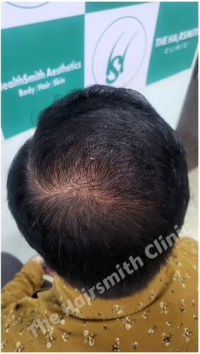 After 10 Months  Hair Transplant Result from The Hairsmith Clinic - 3