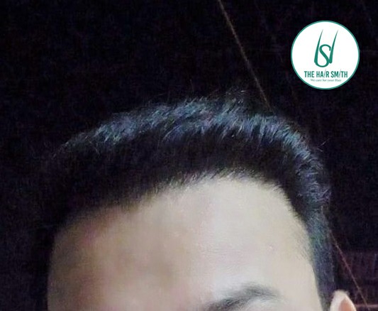 After 07 Months Hair Transplant Results (C)  from The Hairsmith Clinic