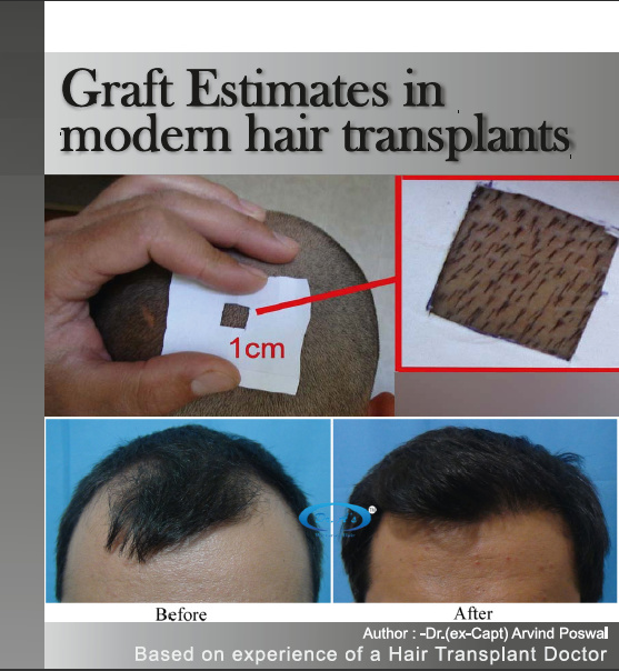 Grafts Estimates in Modern Hair Transplants Cover Page