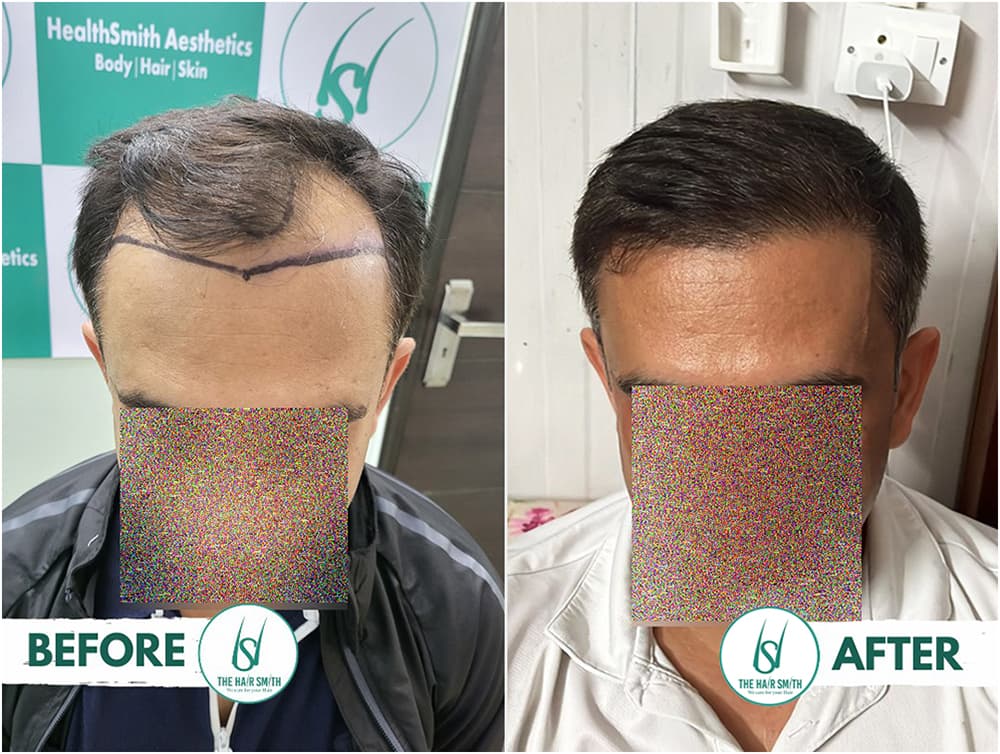 Hair Transplant Hair Line Result   After 06 Months from The Hairsmith Clinic - Best Hair Transplant Clinic in Delhi NCR