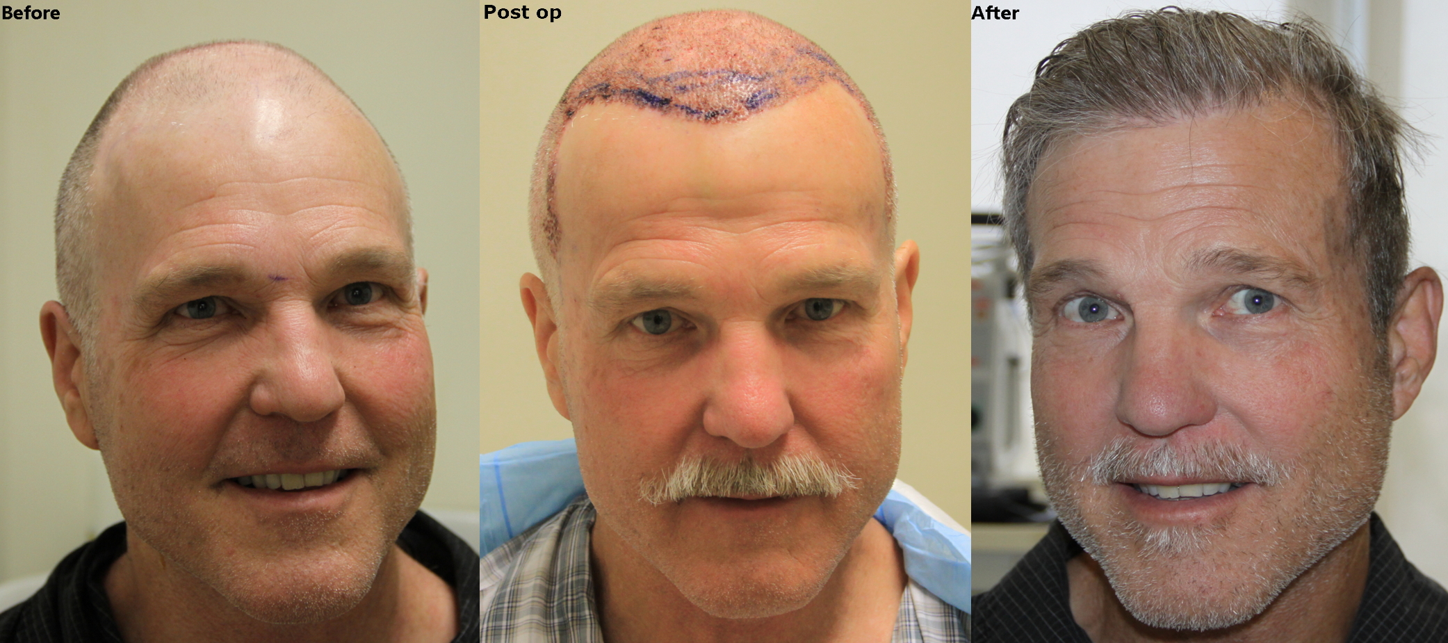 Пересадка волос екатеринбург. Трансплантация волос на бороду. Операция по пересадке волос на бороду.