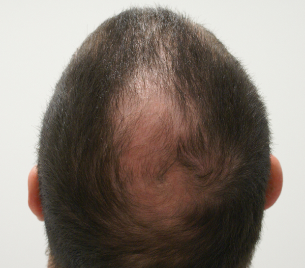 Double whorl crown - FUE 2800 grafts - Prohairclinic - Hair Transplant ...