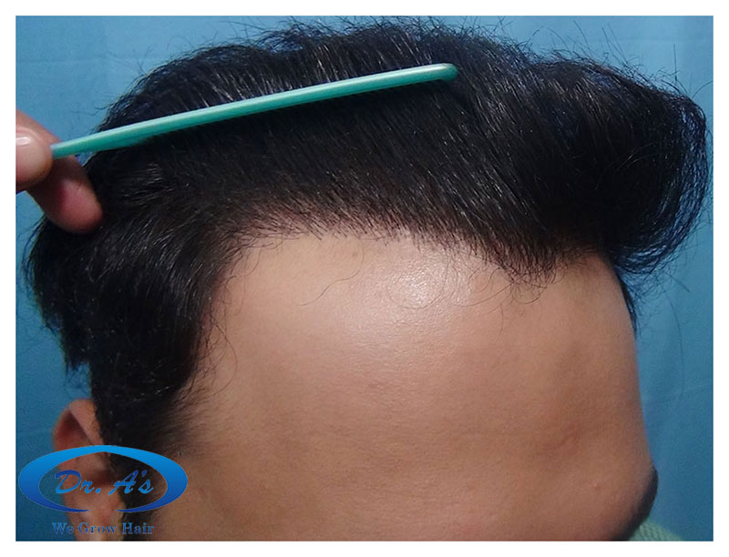 Hair%20Transplant%20Result%20-%20After%20picture%20-%20R156%20-%20dr%20as%20clinic%202