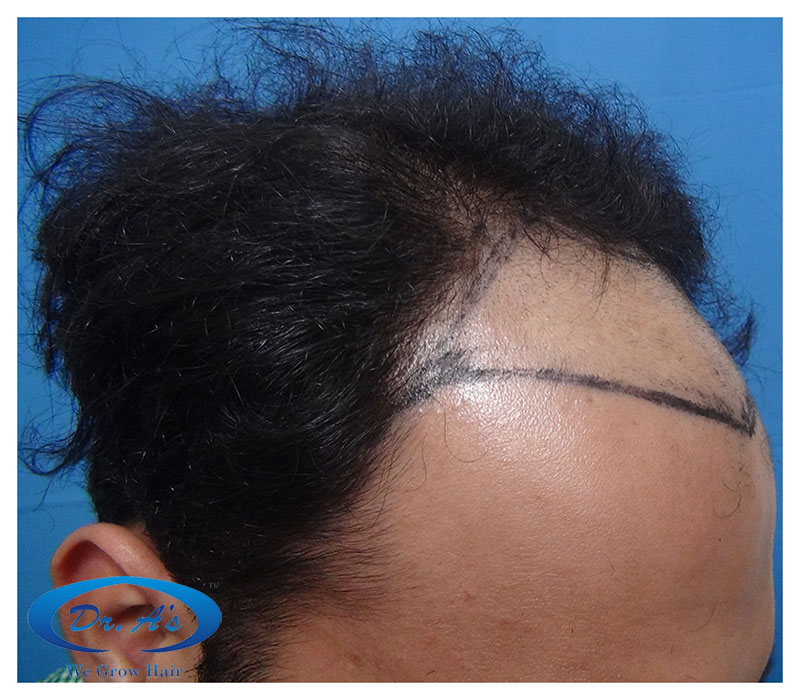 Hair%20Transplant%20Result%20-%20Before%20picture%20-%20R156%20-%20dr%20as%20clinic%202