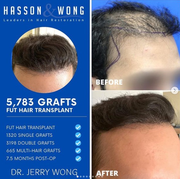 Hasson & Wong - 5783 grafts before and after  months - Hair Transplant  - HairSite - Hair Restoration Forum