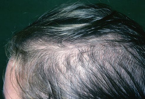 hair_scalp_s9_female_hair_loss