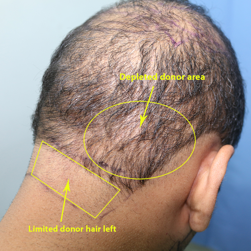 Hair Transplant Donor Scars Horror - GUESS! Who did this? - Hair Transplant  - HairSite - Hair Restoration Forum
