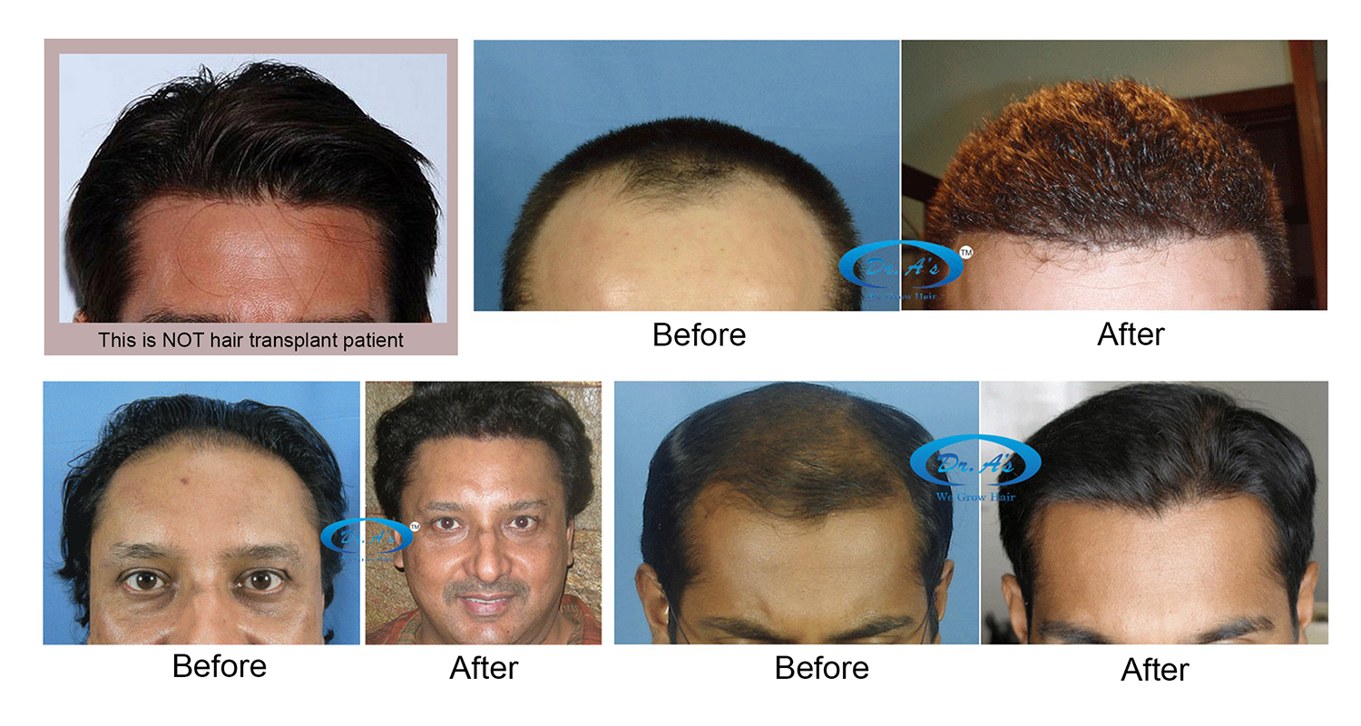 Hair transplant to replicate celebrity hairstyles and hairlines of your  choice - Hair Transplant - HairSite - Hair Restoration Forum