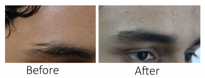 Eyebrow-Restoration37_13