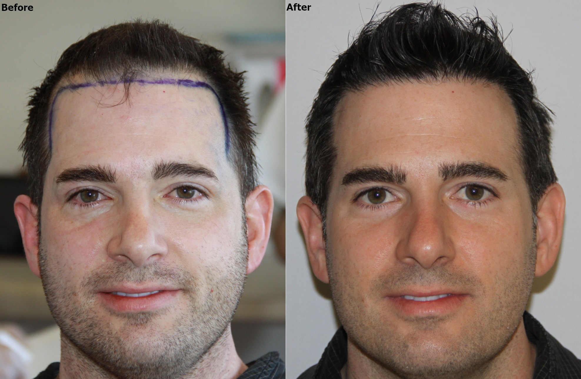 Hairline lowering result by Dr. Baubac (with face showing) 