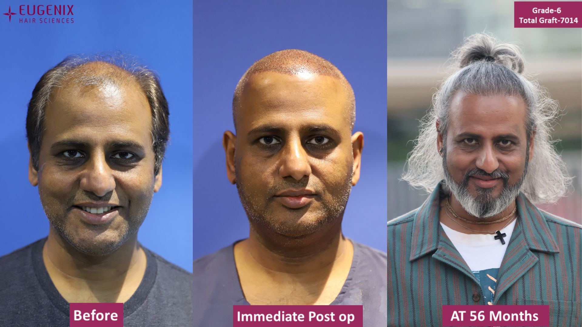 What is the cost of hair transplantation in Indore? - Quora