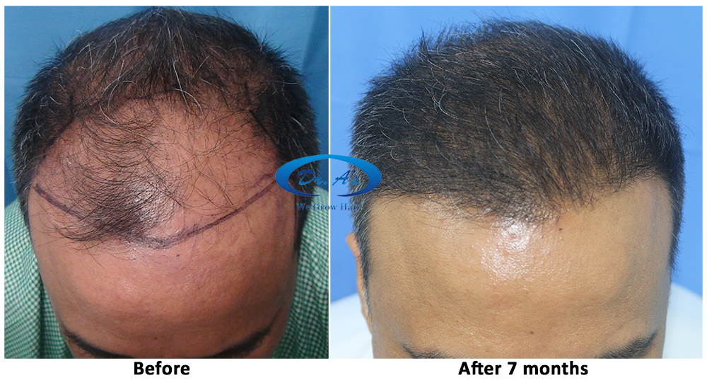 R162 | Total 4362 scalp FUSE/fue grafts - 7 months update | Dr. A's Clinic  - Hair Transplant - HairSite - Hair Restoration Forum