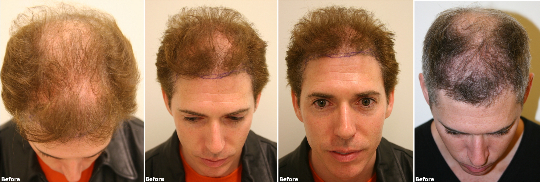Alvi Armani Clinic Hair restoration result 8,000 grafts - Hair Transplant -  HairSite - Hair Restoration Forum