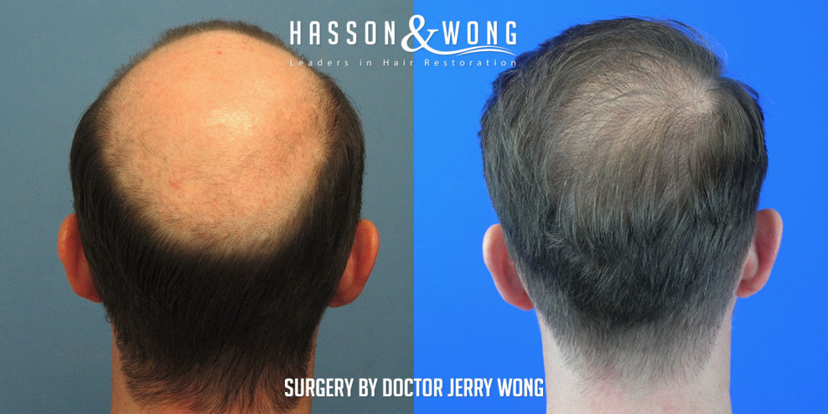 Dr. Jerry Wong FUT Strip transplant 7382 grafts Norwood 6 - - Hair