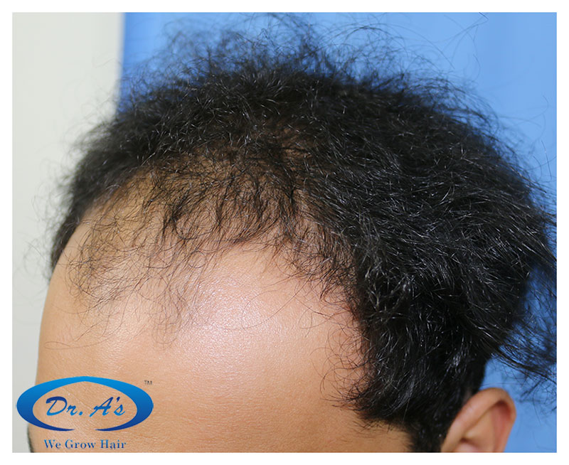 Hair%20Transplant%20Result%20-%20Before%20picture%20-%20R156%20-%20dr%20as%20clinic%201