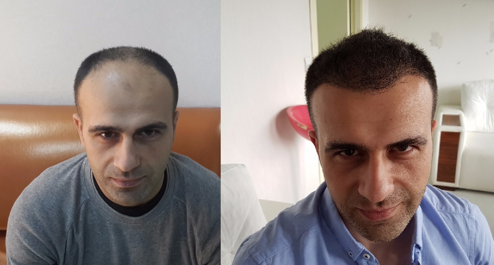 Турецкая пересадка волос. Трансплантация волос в Турции. Операция по пересадке волос. Пересадка волос в Стамбуле.