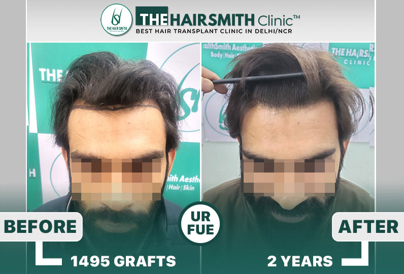 The Hairsmith Clinic - Best Hairline Hair Transplant Result #HairTransplant #TheHairsmithClinic