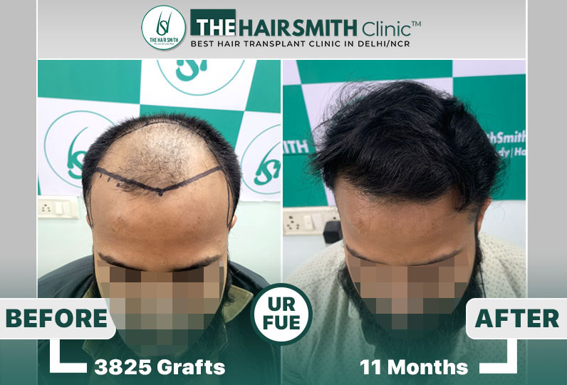 11 months hairsmith hair transplant result - the hairsmith clinic delhi - 3