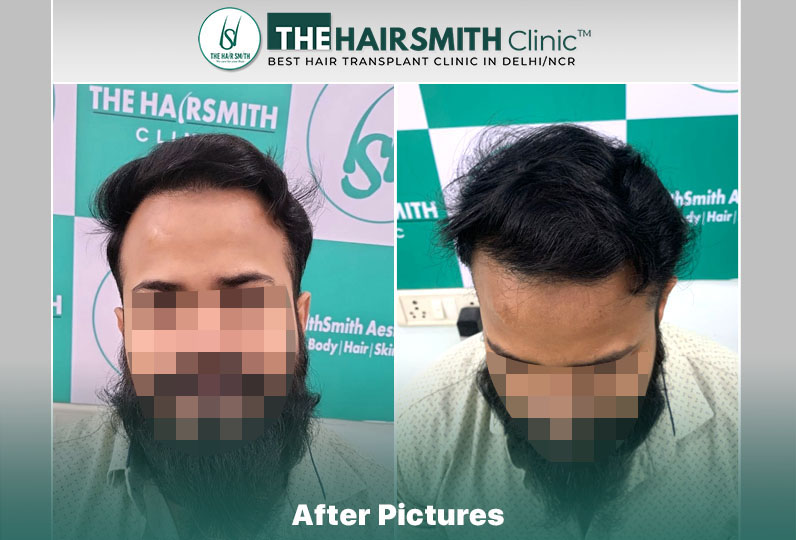 the hairsmith clinic result - 11 months update - 1