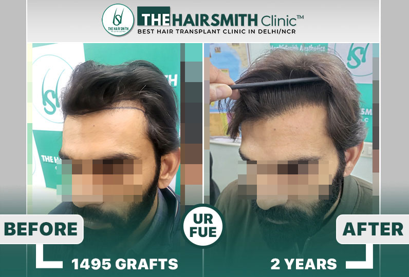 The Hairsmith Clinic - Best Hairline Hair Transplant Result #HairTransplant #HairsmithHairTransplantResults