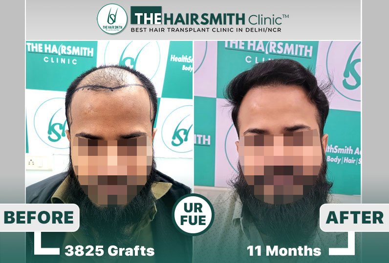 11 months hairsmith hair transplant result - the hairsmith clinic delhi - 2