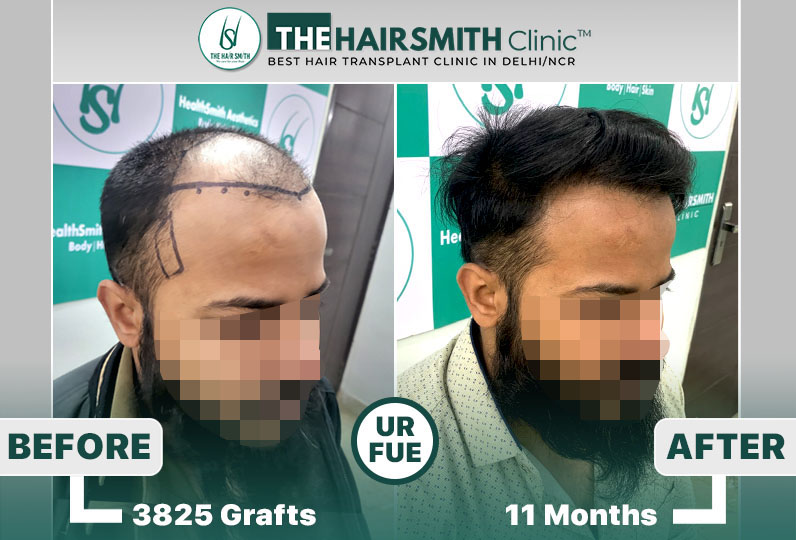 11 months hairsmith hair transplant result - the hairsmith clinic delhi - 4