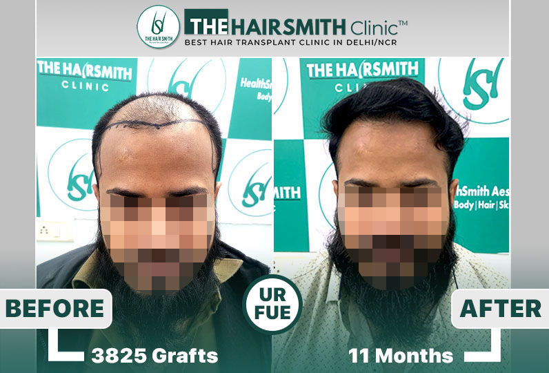 11 months hairsmith hair transplant result - the hairsmith clinic delhi - 1
