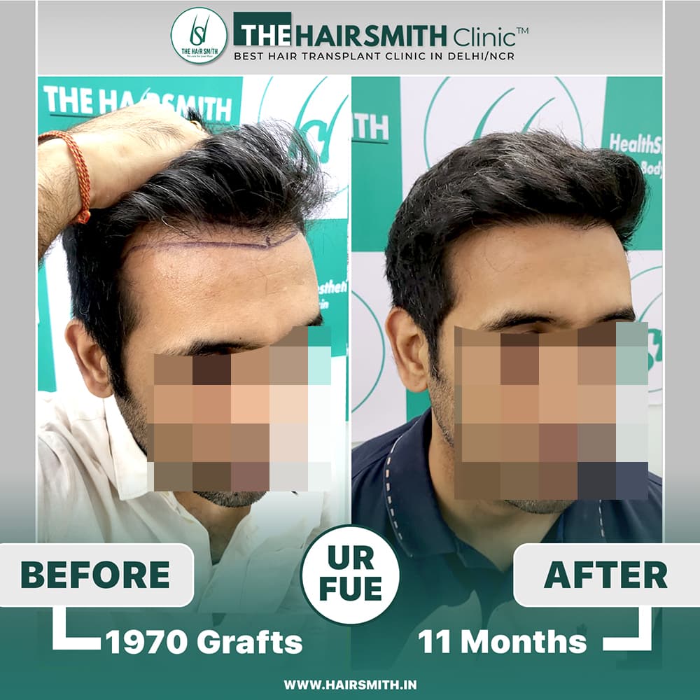 The Hairsmith Clinic Hair Transplant Result - Before and after result 2