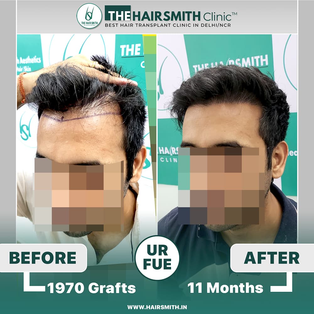 The Hairsmith Clinic Hair Transplant Result - Before and after result 3
