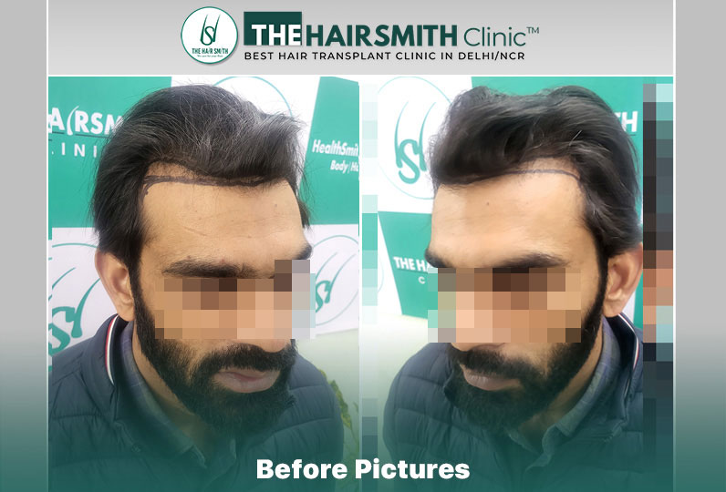 before hair transplant - the hairsmith cliic delhi #hairtransplant #hairlinehairtransplant #hairsmithtransplantrdelhi