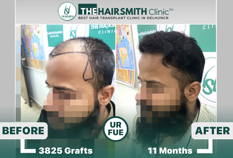 11 months hairsmith hair transplant result - the hairsmith clinic delhi - 5