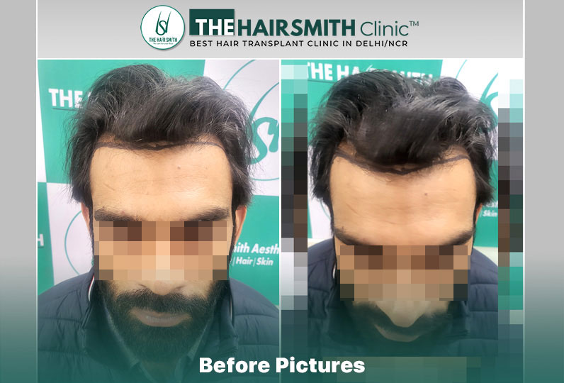 before hair transplant - the hairsmith cliic delhi #hairtransplant #hairlinehairtransplant