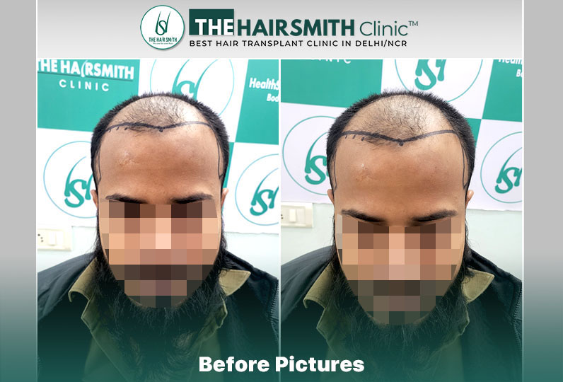Before Hair Transplant HS 833- The Hairsmith Clinic Delhi India - 1