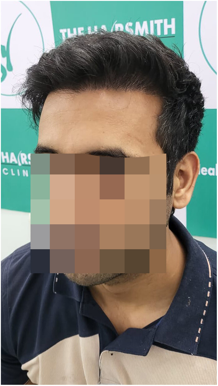 hairsmith clinic - 11 months hair transplant result - 3