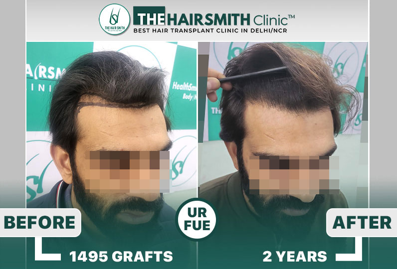 The Hairsmith Clinic - Hairline Hair Transplant Result #HairTransplant #HairsmithTransplantResults