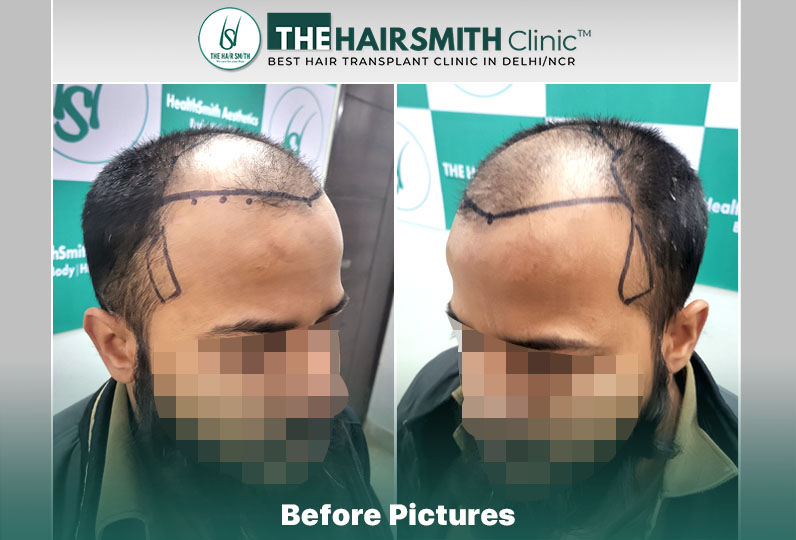 Before Hair Transplant HS 833- The Hairsmith Clinic Delhi India - 3