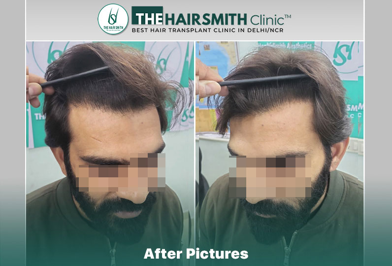 after hair transplant result - the hairsmith cliic delhi #hairtransplant #hairlinehairtransplant