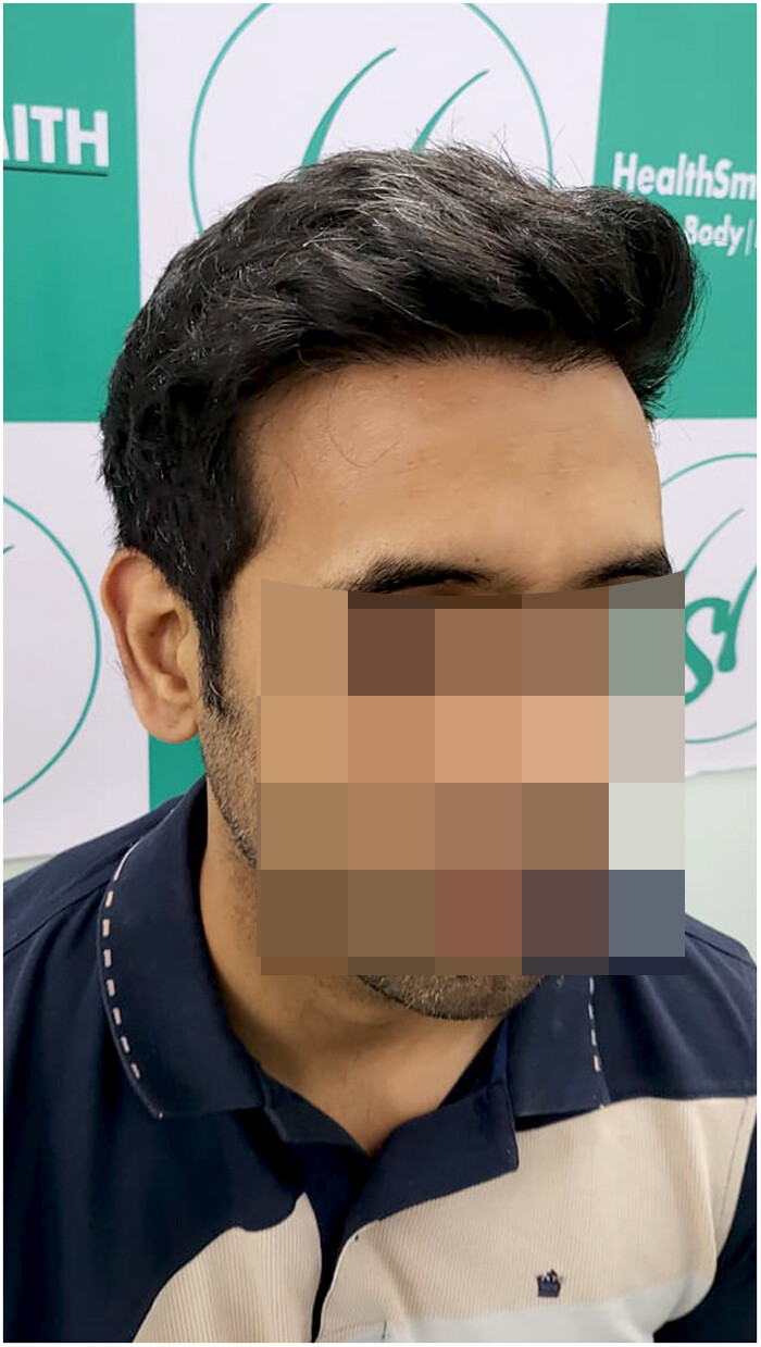 hairsmith clinic - 11 months hair transplant result - 2