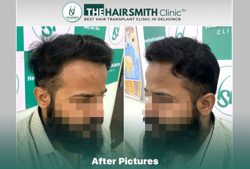 the hairsmith clinic result - 11 months update - 2